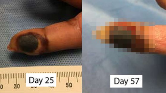 Imaginea articolului FOTO | Experiment cu final cum nu se poate mai prost: Degetul unei femei a început să putrezească, după ce s-a infectat accidental cu un virus